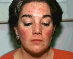File:Rosacea treatment.jpg